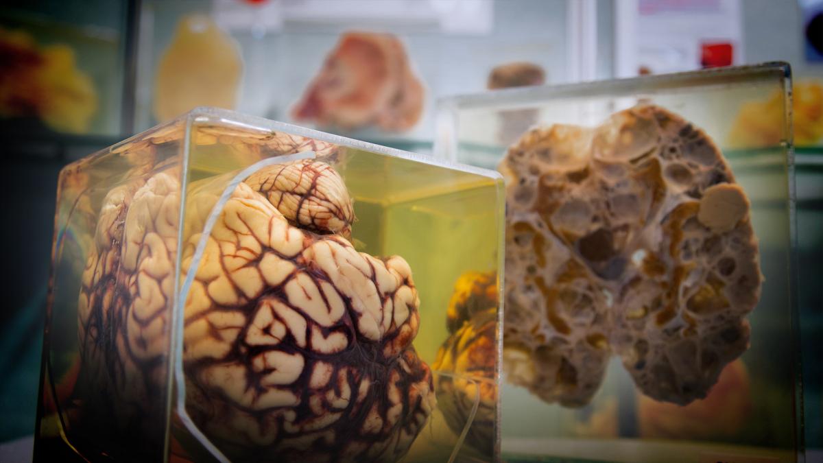 photo of a human organ in glass jar